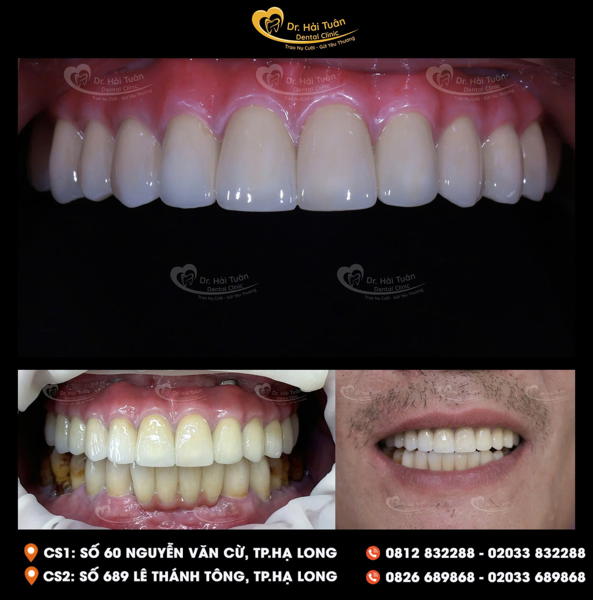 Tái sinh lại hàm răng đã mất bằng phương pháp IMPLANT ALL ON